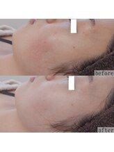 ヴェルシック(Belchic)/むくみとたるみ改善をまとめて