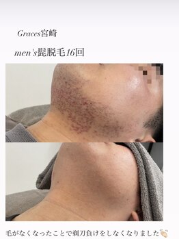 グレーシス(Graces)/メンズ髭脱毛