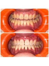 コナホワイトニング 神保町/ホワイトニング