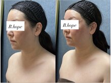 ビーホープ(B.hope)/40代モニター様1回目の変化