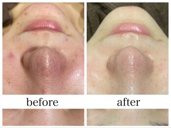 アリエスの写真/【毛穴の黒ずみ撲滅】毛穴特許技術で汚れゴッソリ除去！他とは違う美容液毛穴洗浄でなめらかつるん肌