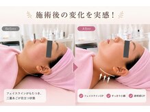 イトウサロン(ITO SALON)の雰囲気（フェイスラインすっきり♪施術後の変化を実感◎）