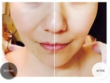 ベル(Belle)/〈症例〉ほうれい線たるみ改善