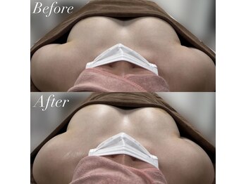 ブレスト サロン 奈良店(Bryst Salon)/バストアップ症例