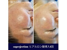 水光ピールスキンの雰囲気（スーパージェクションヒアルロン酸導入1回目ビフォーアフター）