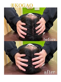 花園わだち整骨院/美小顔矯正ビフォーアフター