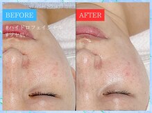 ティアワン 麻布十番(Tierone)/ハイドロBefore & After