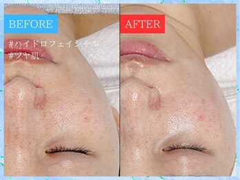 ティアワン 麻布十番(Tierone)/ハイドロBefore & After