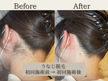 インベスト(INVEST)/うなじ脱毛