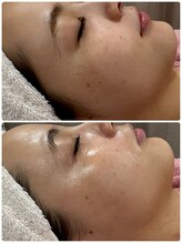 エーエフビューティーエステ(AF Beauty Esthetic)/敏感肌・乾燥肌フェイシャル