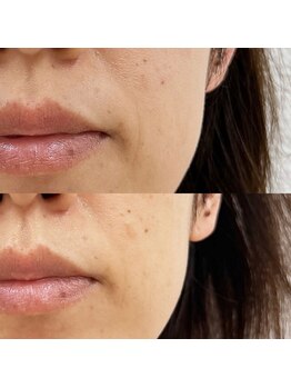 オンフリーク(ON FLEEK)の写真/ダウンタイムや痛みほぼなし！「エステ版ダーマ」でほうれい線・たるみ・お肌の凹凸をケア♪