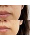 オンフリーク(ON FLEEK)の写真/ダウンタイムや痛みほぼなし！「エステ版ダーマ」でほうれい線・たるみ・お肌の凹凸をケア♪