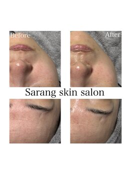 Sarang skin salon/川西｜リフトアップケア