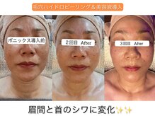 温和活 ロータス(温和活Lotus蓮:)/毛穴ハイドロ＆美容液導入