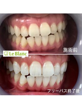 ルブラン 奈良店(Le Blanc)/イベント前にホワイトニング！！