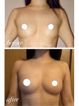 サロンツキ(salon tuki)/【バストケア】症例★
