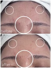 グレイス アンド ミューズ(grace&muse)/産毛waxうるすべ肌実感コース