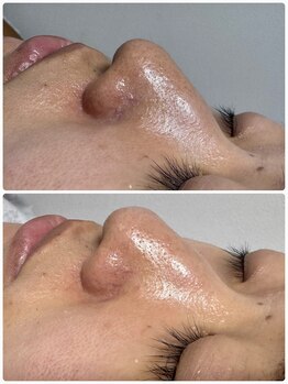 ナチュールムーン(Nature moon.)/毛穴洗浄