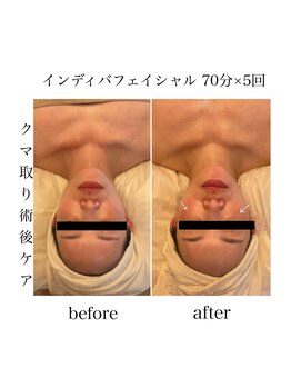 ファミーユ 名古屋店/【術後ケア】フェイシャルケア