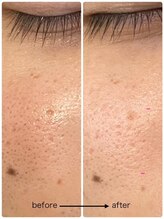 ラ メール ヴィーヴル/【毛穴ケア】