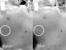 ルノン(Lunon)/毛穴洗浄ハイドロ×ララピール