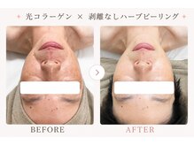 パールプラス 大田原店(Pearl plus)/複数回の施術でお肌悩みが改善