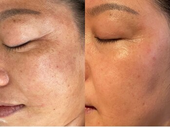 リモーブ(Limauve)/ハーブピーリング