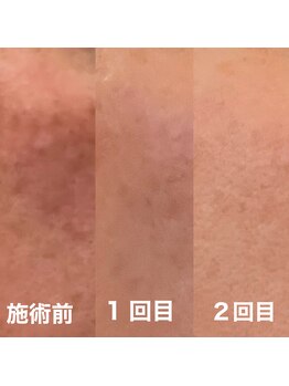 サロンドアモール(Salon de a mole)/ハーバルシーメソッド/シミ