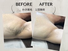 ワンアップ(One-up)/わき脱毛 １回　before  after