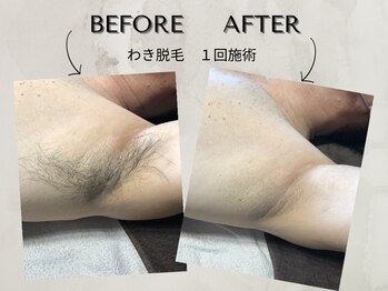 ワンアップ(One-up)/わき脱毛 １回　before  after