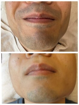 ロシェル(Rochell)/【ヒゲ脱毛】