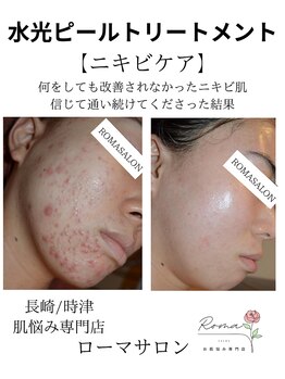 ローマサロン/本気のニキビケア!素肌美人♪