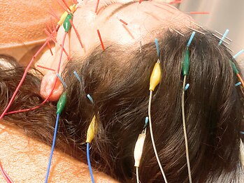 健美庵の写真/【人気No.1】年齢肌の悩みと首肩の辛さを同時ケア♪電気美容鍼と首肩のマッサージで肌と体をしっかりケア！