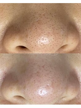 カランコエ(KALANCHOE)/気になる毛穴の黒ずみにも