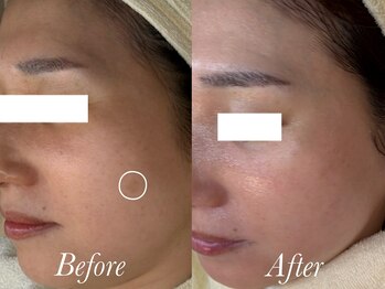 ローズルート(Rose route)/40代前半ママさん 4回施術