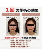 クローバー鍼灸整骨院/美容鍼+小顔矯正マッサージ