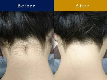 フローラル ビューティー(Floral-Beauty)/【うなじ脱毛】うなじ脱毛/襟足