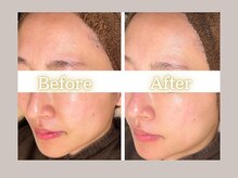 ハル(HARU.)/ハーブピーリング