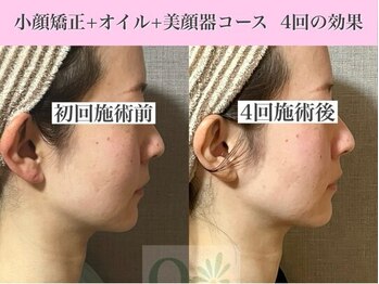 キュープ 福岡大牟田店(Qpu)/美顔器モニターコース4回の変化