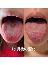 シェリー(Cherie)/【ニキビケア】口腔内から見る