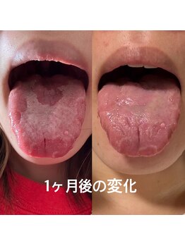 シェリー(Cherie)/【ニキビケア】口腔内から見る