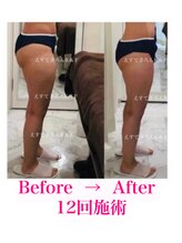 えすてさろん ケイアンドエフ(k&f)/施術結果12回/20代