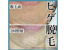 ツバキ(TSUBAKI)/ヒゲ脱毛