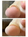 一度の施術でこの効果！