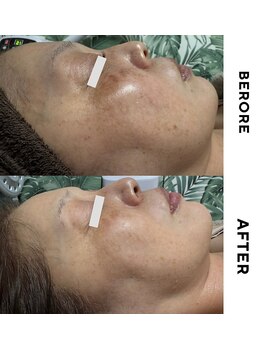 ゼロ 水戸店(ZERO)/シミ・シワ肌質改善スペシャル