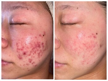 ブレアドール(Blair-Doll)/繰り返すニキビに☆