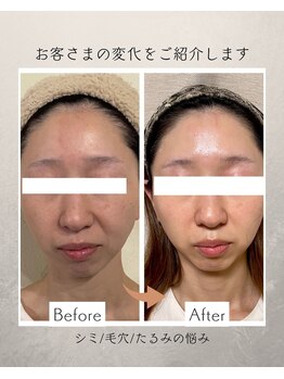 コーヴォ(COVO)/【ホワイトスノーピール】