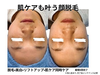 エイチケービューティーサロン(H/K beauty salon)/【肌ケアも同時にできる脱毛】