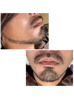 エステサロン桜/【根元からゴッソリ！】