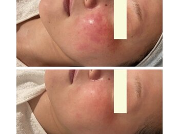 アンリアン 銀座店(Une Lien)/アクアダーマ結果写真